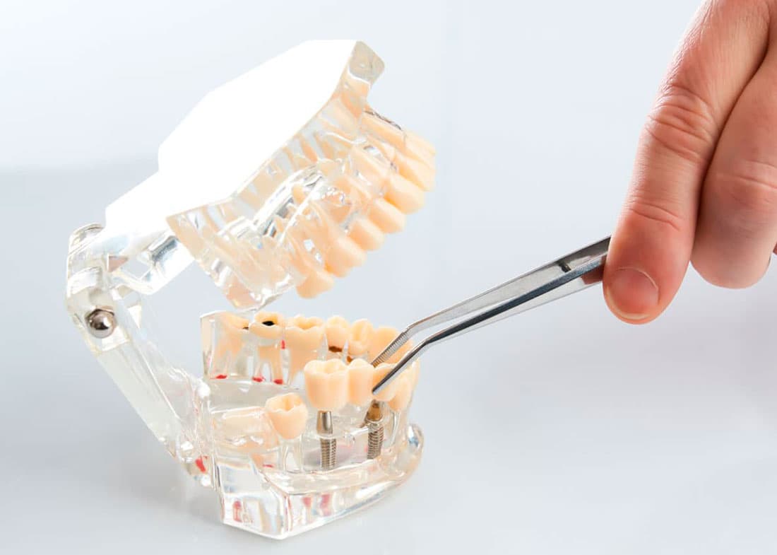 Prótesis dental fija en A Coruña